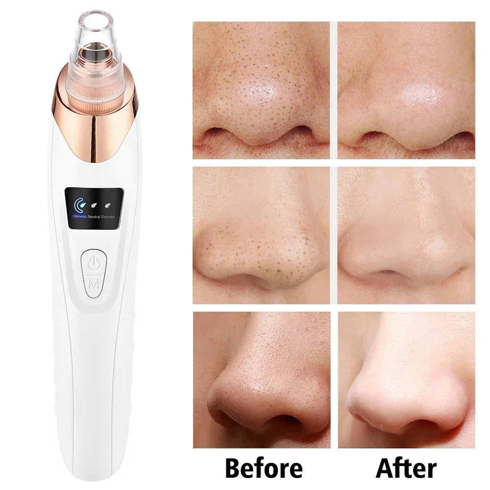 Dermativa PoreClean™Herramienta de limpieza profunda de poros