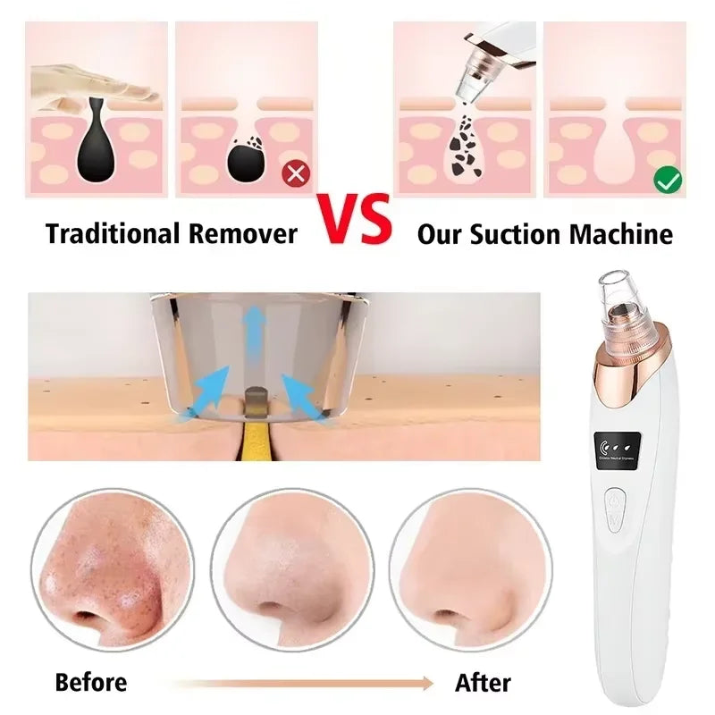 Dermativa PoreClean™Herramienta de limpieza profunda de poros